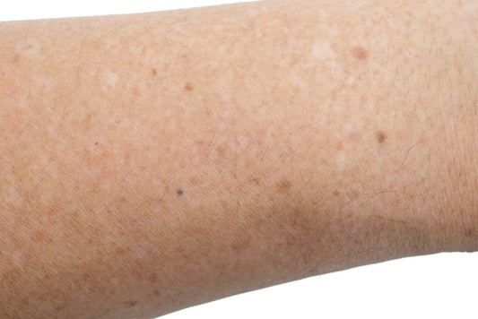 What Home Remedies To Get Rid Of Dark Spots On Hands and Legs