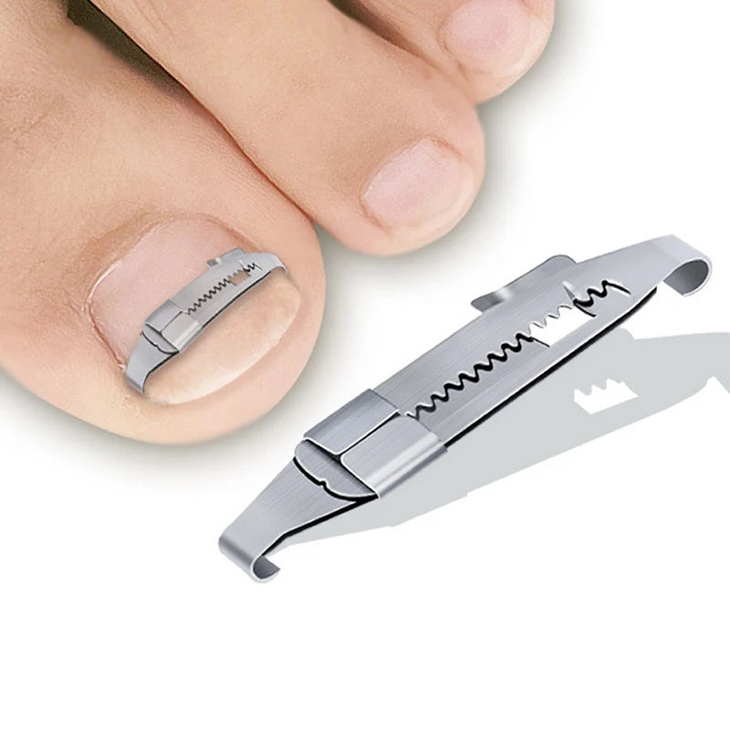 Ingrown Toenail Corrector Tool