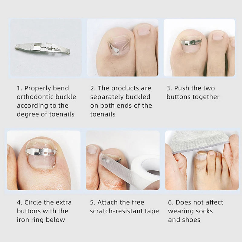 Ingrown Toenail Corrector Tool